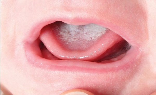nấm miệng ở trẻ sơ sinh